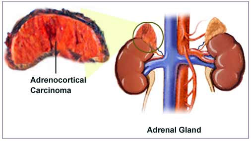 Adrenocortical Carcinoma Treatment: Services and Research Synergies for Future Advancements | DLI