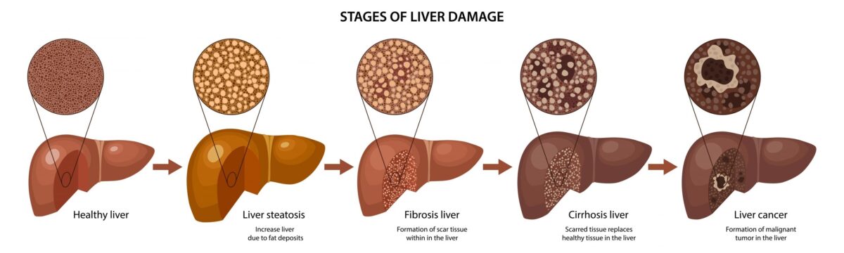 Cirrhosis Disease: Market Insights – Key Players and Strategies | DLI