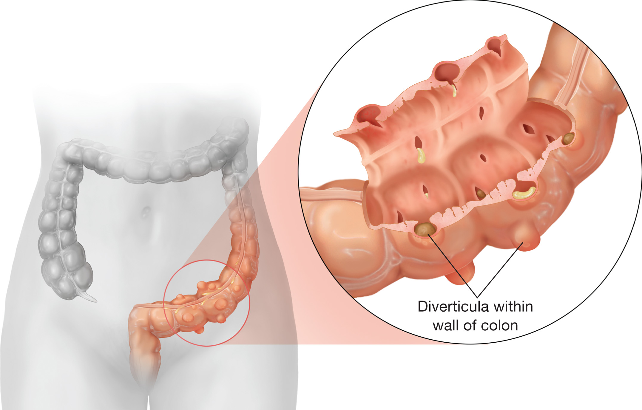 Diverticulitis Chronicles: Market Trends and Outlook Insights | DLI