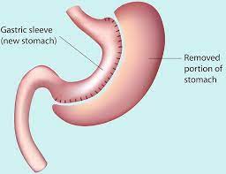 hypnotic gastric band