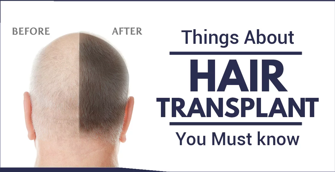 Finding the Right Qualified Professional for Successful Hair Transplants